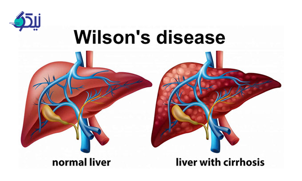بیماری ویلسون 