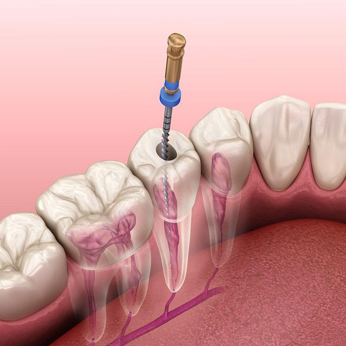 آشنایی با روش های مختلف درمان ریشه دندان