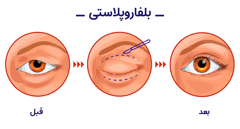 بلفاروپلاستی