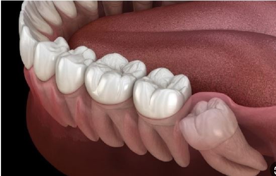 انواع درد دندان و علت آن