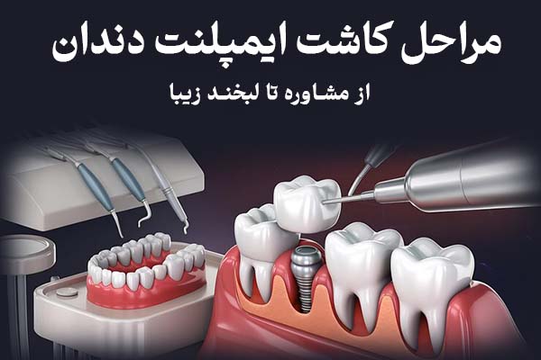 ایمپلنت دندان