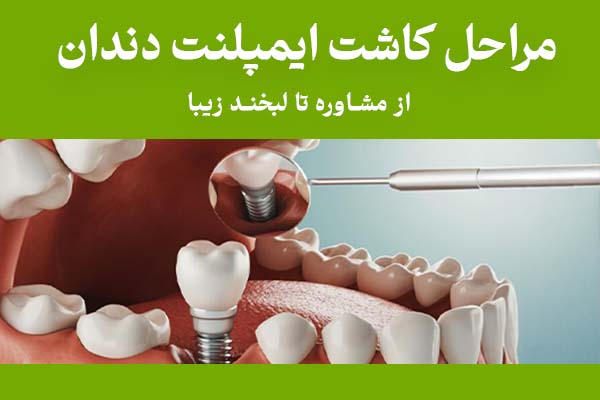 مراحل کاشت ایمپلنت دندان: از مشاوره تا لبخند زیبا
