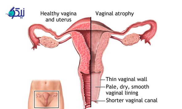 آتروفی واژن
