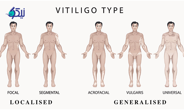 انواع ویتیلیگو