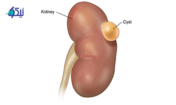 کیست کلیه