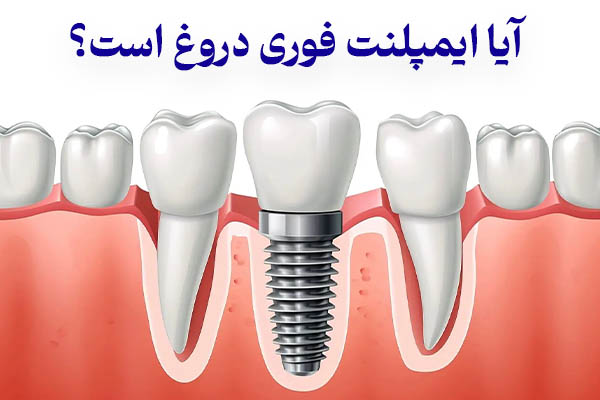 ایمپلنت فوری