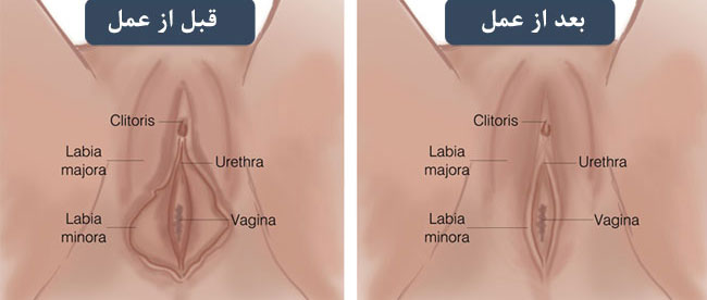 لابیاپلاستی