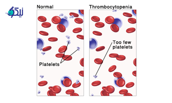 ترومبوسیتوپنی 