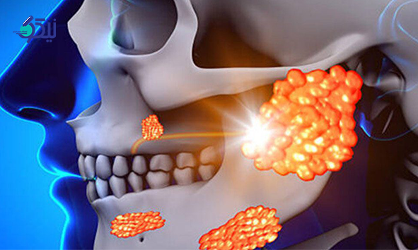 تومورهای فک و کیست 